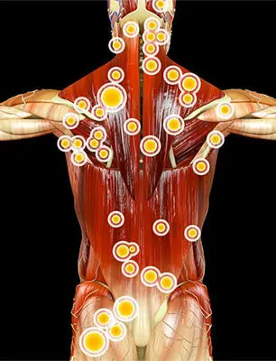 Triggerpunkte im Körper